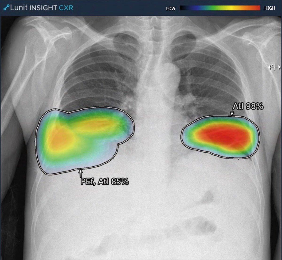 Lunit INSIGHT CXR output on a chest X-ray, via Vertex in Healthcare (manufacturer image)