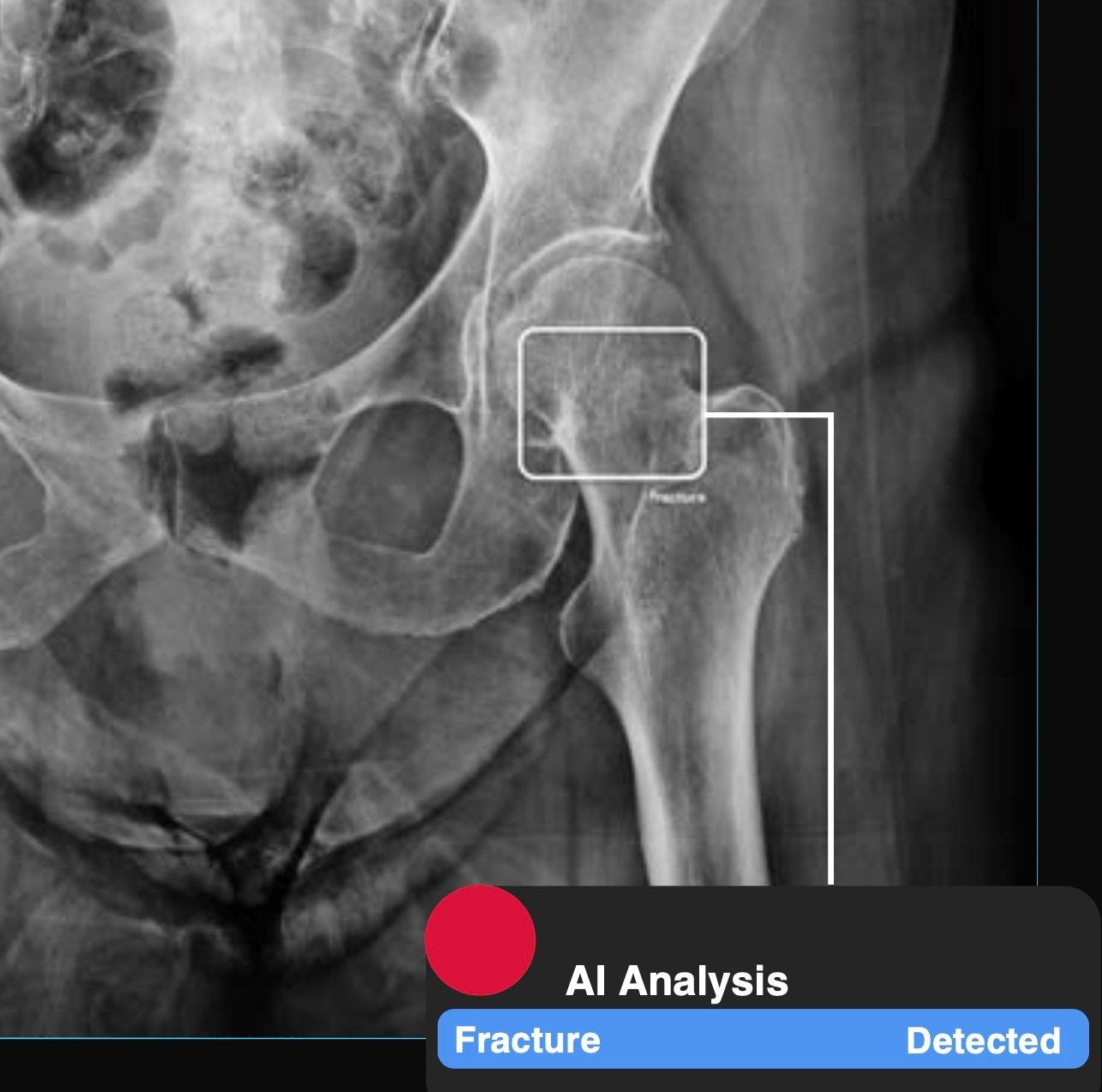 RBfracture™ output, via Vertex in Healthcare (manufacturer image)
